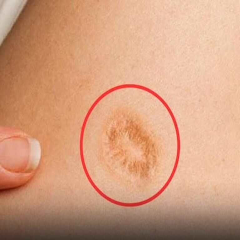 Você tem uma marca redonda no braço? Descubra o que
